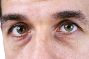 under eye swelling