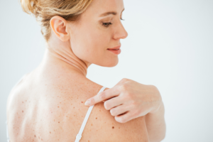 skin cancer pictures early stages