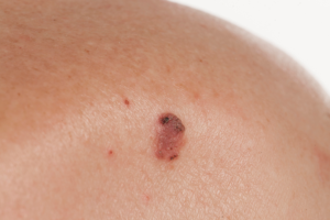 what is skin cancer