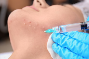 is hyaluronic acid good for dry skin