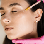 melasma tranexamic acid
