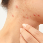 can pimples itch