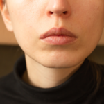 pimples vs herpes