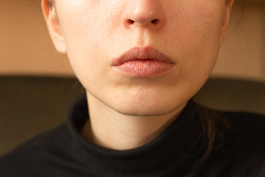 pimples vs herpes