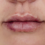 How long does lip filler bruising last
