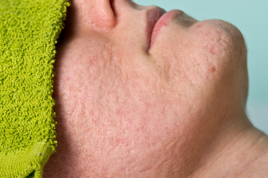 Should i see a dermatologist for acne scars
