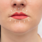 why does lip filler migrate above lip