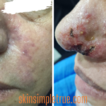 signs of vascular occlusion after lip filler