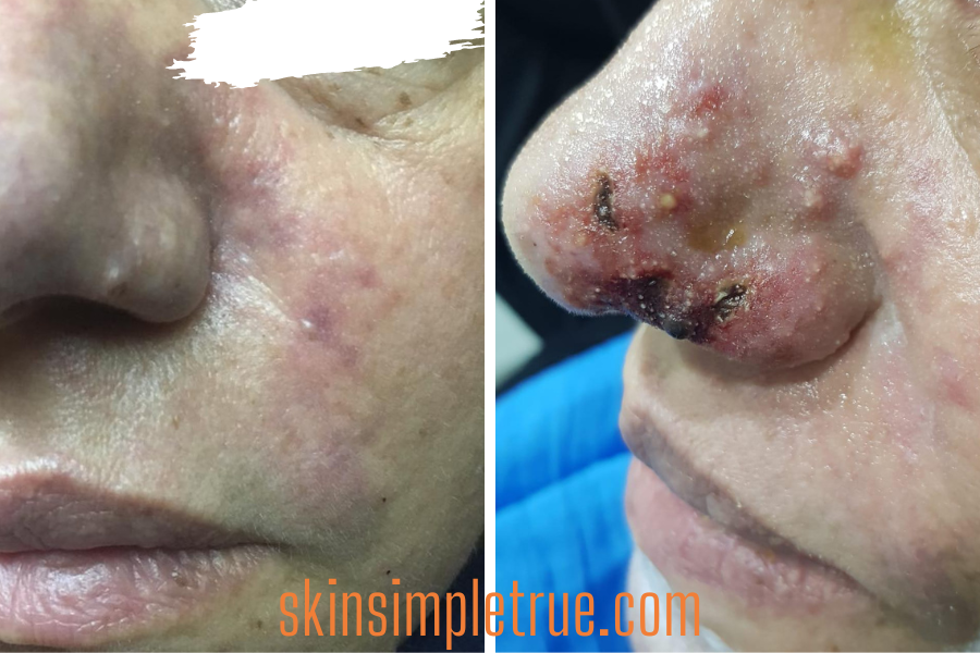 signs of vascular occlusion after lip filler