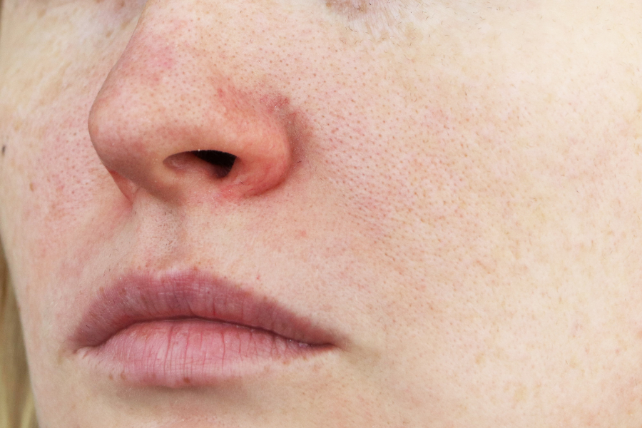 azelaic acid rosacea