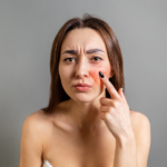is salicylic acid good for rosacea