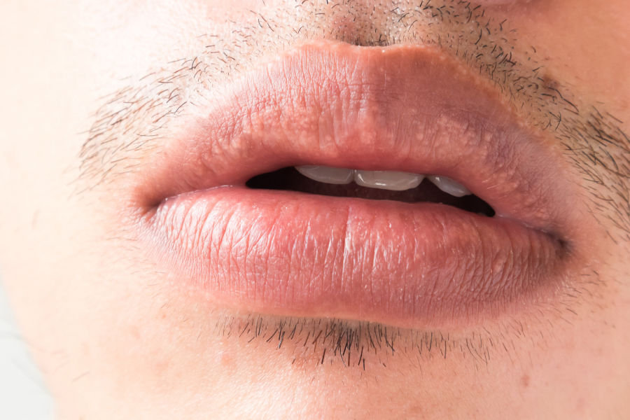 lip balm hyaluronic acid