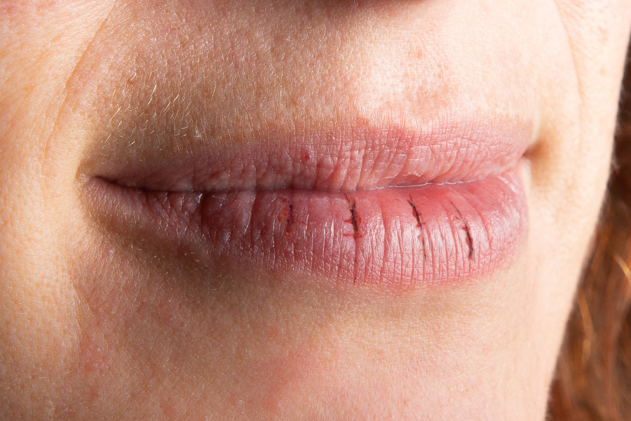lip eczema