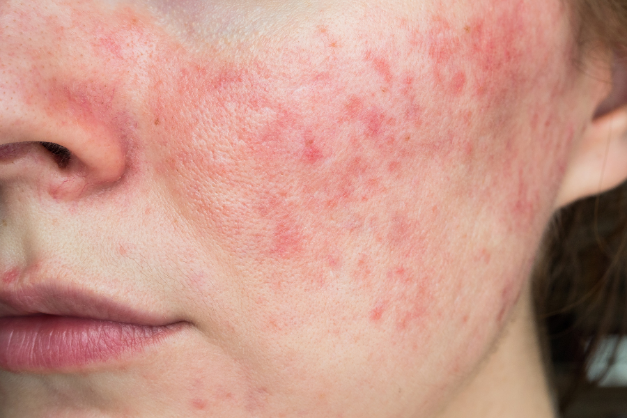 best exfoliant for rosacea