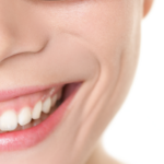how many units of botox for gummy smile