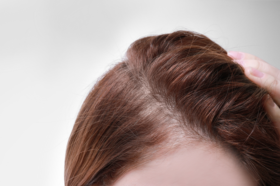 when does postpartum hair loss stop