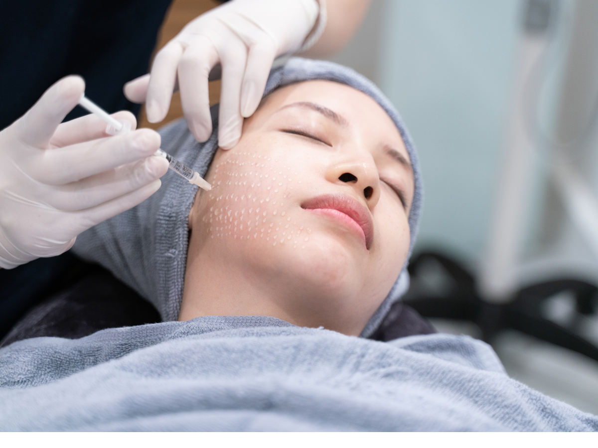 Oral tranexamic acid melasma