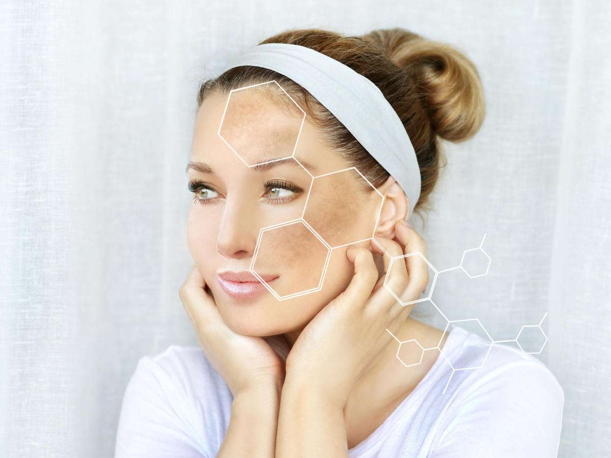 Tranexamic acid 250 mg tablet for melasma