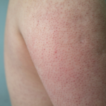 Keratosis pilaris natural remedy treatment