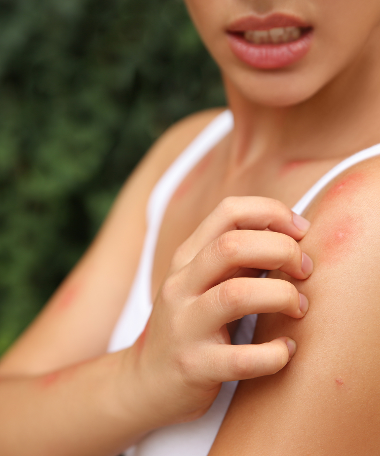 natural remedies for mosquito bites itch relief