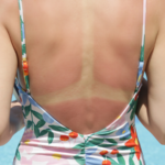 sunburned skin remedies