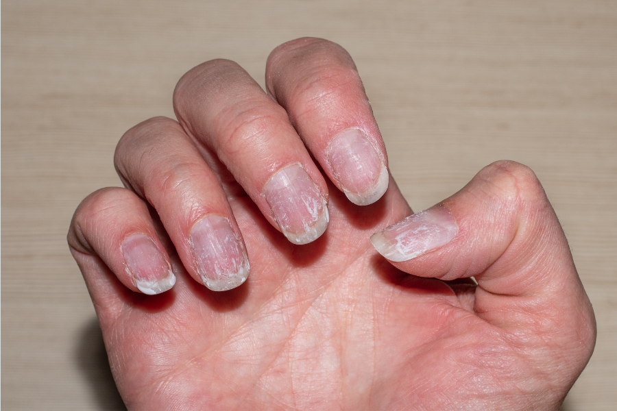 damaged nails after acrylics