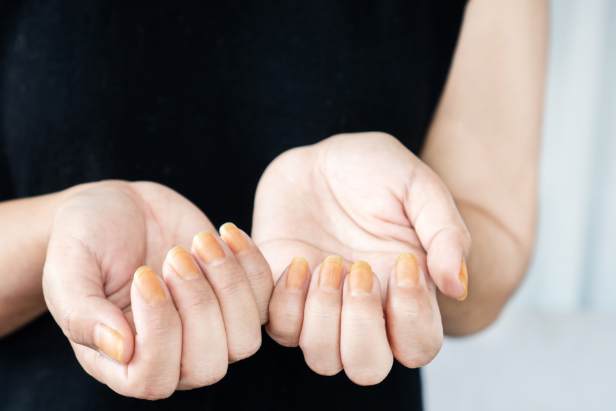 yellow nails after nail polish