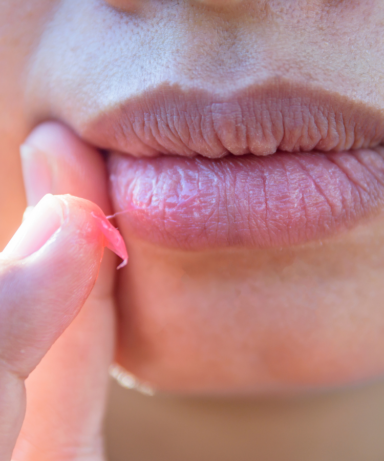severe chapped lips remedy